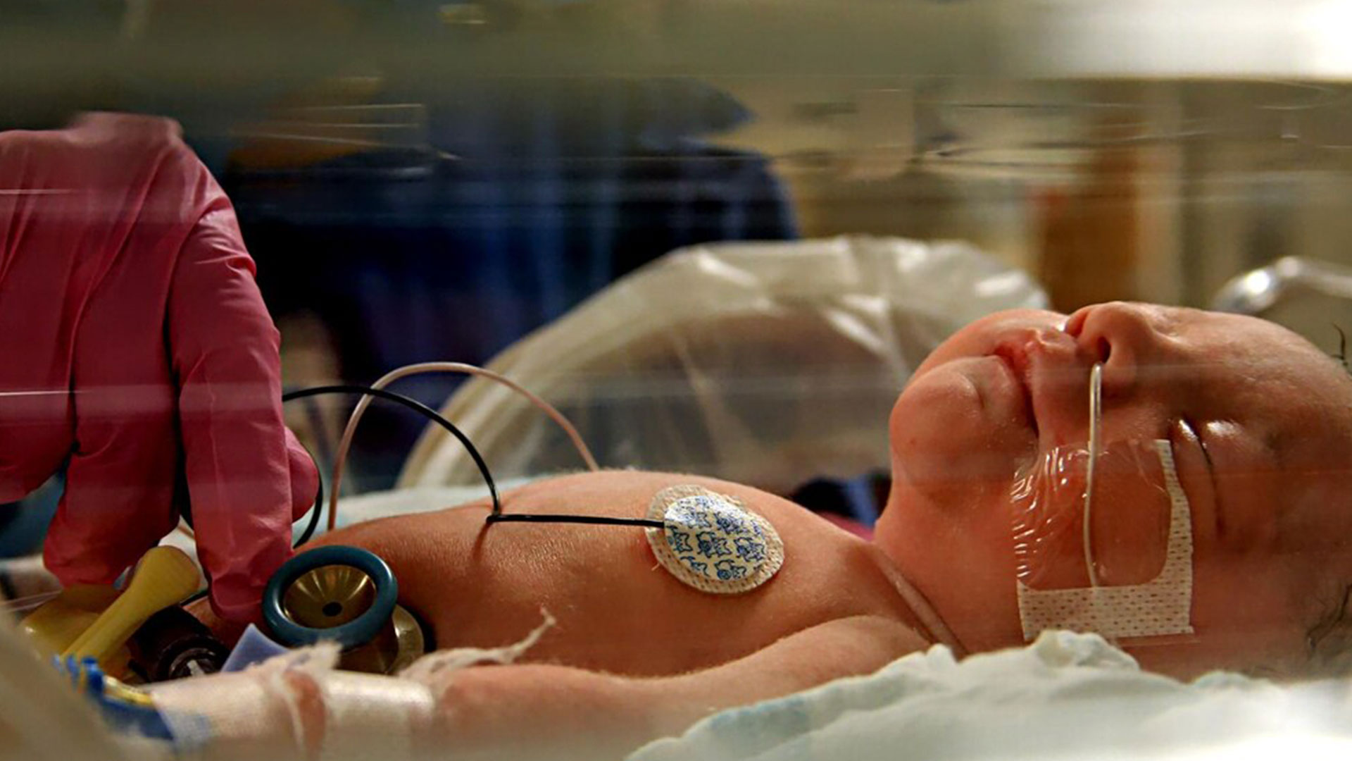 Falta de oxigênio ao nascer: protegendo o futuro de milhares ​de crianças